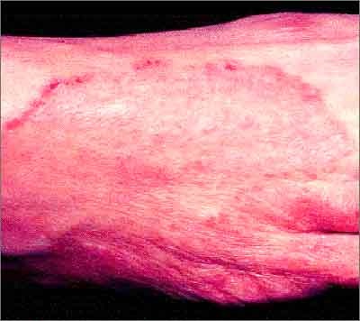 Bệnh da mùa lũ  - 1