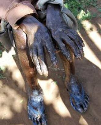 Bệnh hoại tử da kinh hoàng do côn trùng - 1