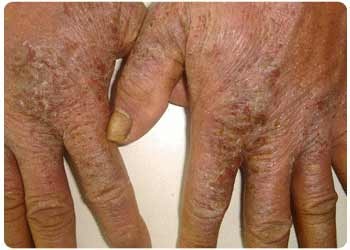 Có thể điều trị được chàm? - 1 Có thể điều trị được chàm? - 1