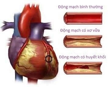 Hồi phục sau cơn nhồi máu cơ tim - 1 Hồi phục sau cơn nhồi máu cơ tim - 1