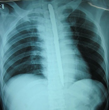 Nuốt dao nhọn dài 15cm để… tự tử - 1 Nuốt dao nhọn dài 15cm để… tự tử - 1