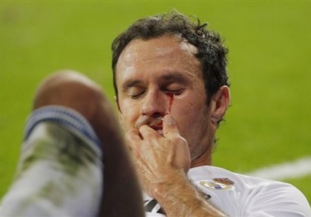 Carvalho đổ máu sau trận derby Madrid - 1