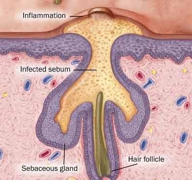 Tại sao bổ sung vitamin lại trị được mụn? - 1 Tại sao bổ sung vitamin lại trị được mụn? - 1