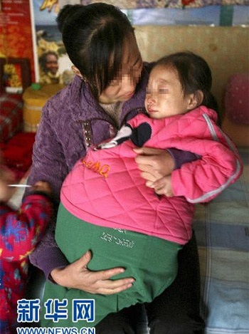 Bé gái 4 tuổi bụng phình to khác thường - 3