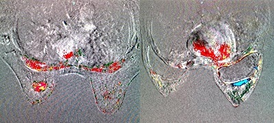 Tiến bộ y học về bệnh ung thư vú - 3 Tiến bộ y học về bệnh ung thư vú - 3