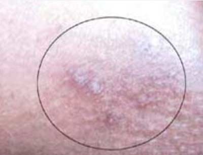 TP Huế: Xuất hiện “côn trùng lạ” gây ngứa - 1 TP Huế: Xuất hiện “côn trùng lạ” gây ngứa - 1