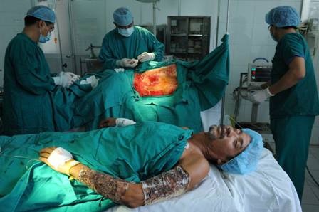 Ghép da đồng loại cứu sống bệnh nhân bỏng toàn thân - 1 Ghép da đồng loại cứu sống bệnh nhân bỏng toàn thân - 1