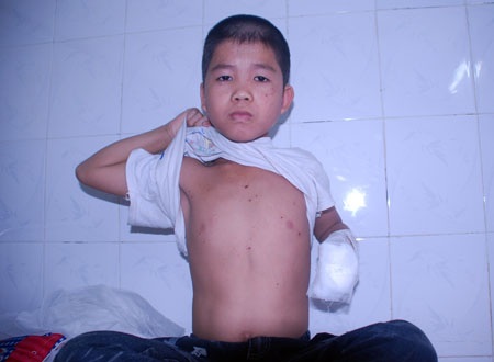 Nghịch kíp mìn, một học sinh phải tháo nhiều ngón tay - 2 Nghịch kíp mìn, một học sinh phải tháo nhiều ngón tay - 2