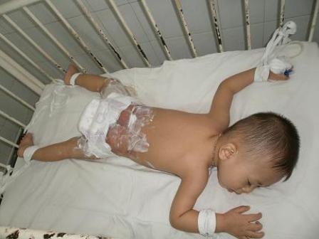 Bé trai bỏng nặng vì ngã vào nồi canh - 1