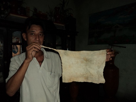 Phát hiện gạc y tế trong bụng bệnh nhân sau phẫu thuật - 1