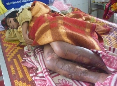 Vấp phải can xăng, cả nhà gặp nạn - 1