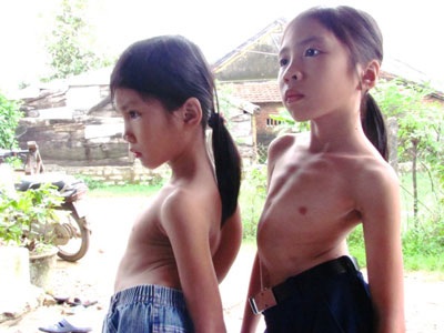 Nhói lòng trước gia đình có 3 cô con gái nhỏ đều bị vẹo cột sống - 1 Nhói lòng trước gia đình có 3 cô con gái nhỏ đều bị vẹo cột sống - 1