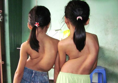 Nhói lòng trước gia đình có 3 cô con gái nhỏ đều bị vẹo cột sống - 2 Nhói lòng trước gia đình có 3 cô con gái nhỏ đều bị vẹo cột sống - 2