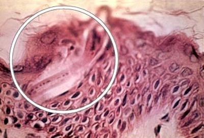 Biểu hiện khi cơ thể nhiễm giun móc - 1 Biểu hiện khi cơ thể nhiễm giun móc - 1