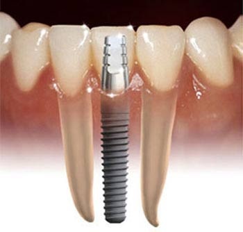 Lưu ý khi thực hiện kỹ thuật trồng răng implant - 1