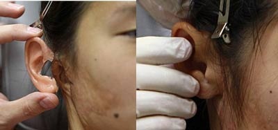 Ghép tai giả cho bé gái 14 tuổi - 2