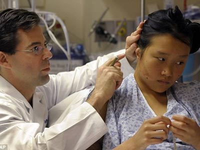 Ghép tai giả cho bé gái 14 tuổi - 1