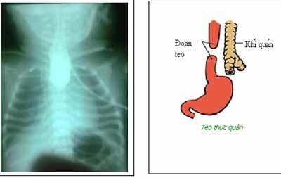 Một trẻ sơ sinh bị teo thực quản bẩm sinh - 1 Một trẻ sơ sinh bị teo thực quản bẩm sinh - 1