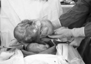 Phẫu thuật thành công khối u buồng trứng nặng 6kg - 1 Phẫu thuật thành công khối u buồng trứng nặng 6kg - 1