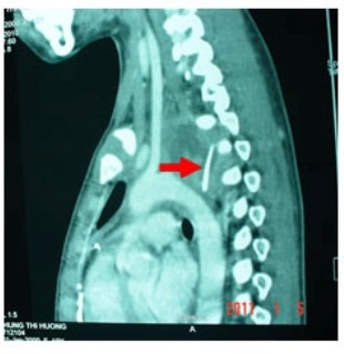 Xương gà đâm thủng thực quản, cháu bé suýt tử vong - 1