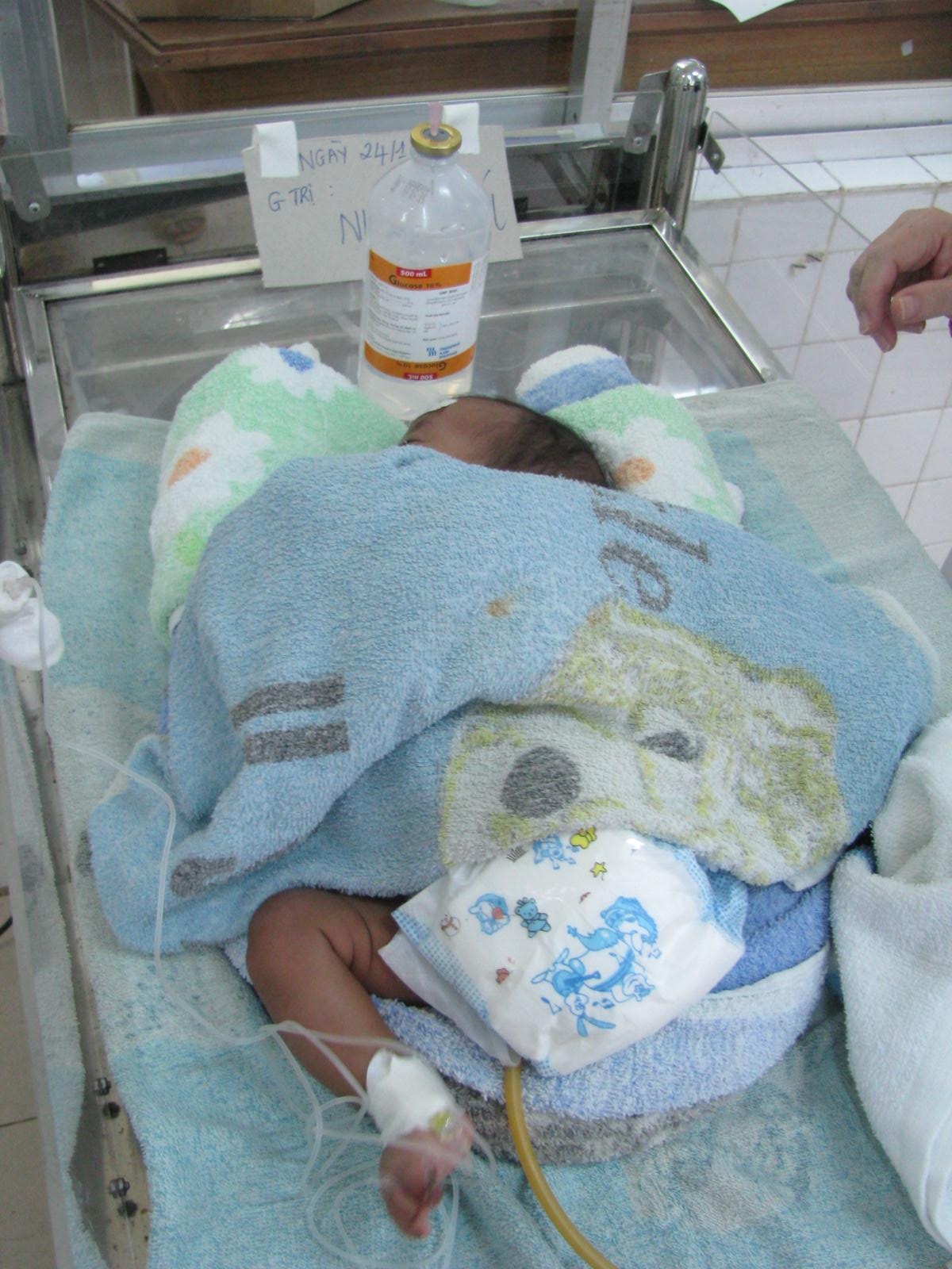 Bé 9 ngày tuổi bị bỏng nặng mất chân trái - 2