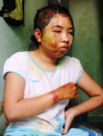 Thiếu nữ bị cha dượng dội nước sôi lên người ký đơn bãi nại - 1