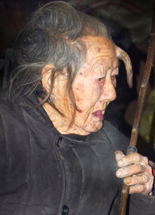 Sừng trên trán cụ bà 102 tuổi dài gấp đôi sau 1 năm - 2