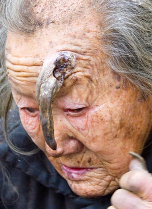 Sừng trên trán cụ bà 102 tuổi dài gấp đôi sau 1 năm - 1