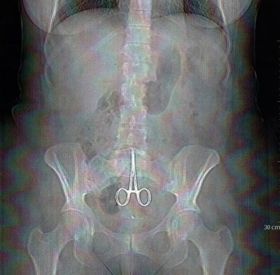 Sống với cây kéo mổ bị quên trong bụng suốt 5 tháng - 1 Sống với cây kéo mổ bị quên trong bụng suốt 5 tháng - 1