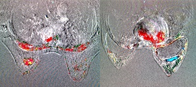Vì sức khỏe cộng đồng: Chẩn đoán sớm ung thư vú - 2 Vì sức khỏe cộng đồng: Chẩn đoán sớm ung thư vú - 2
