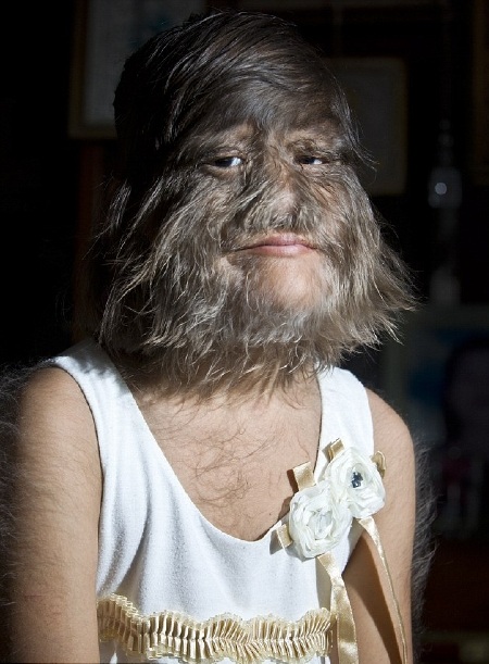 Bé gái 11 tuổi mắc chứng rậm lông  - 1