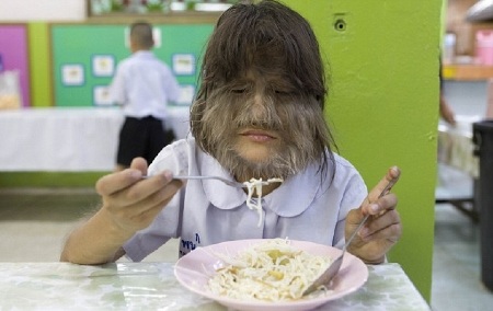 Bé gái 11 tuổi mắc chứng rậm lông  - 3