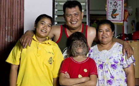 Bé gái 11 tuổi mắc chứng rậm lông  - 4