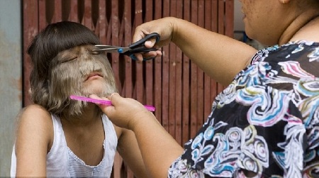 Bé gái 11 tuổi mắc chứng rậm lông  - 6