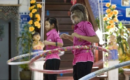 Bé gái 11 tuổi mắc chứng rậm lông  - 7