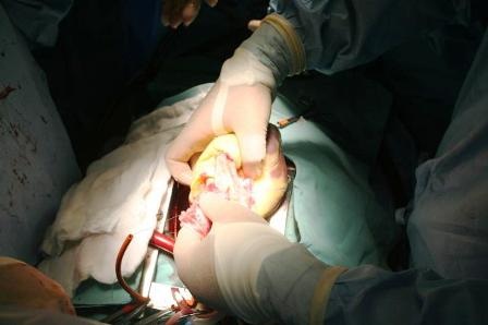 Thành công ca ghép tim do 100% bác sĩ Việt đảm nhiệm - 2 Thành công ca ghép tim do 100% bác sĩ Việt đảm nhiệm - 2