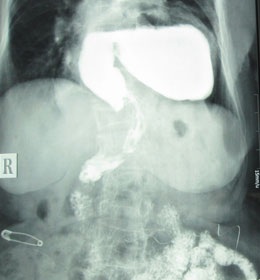 Cụ bà 80 tuổi có dạ dày và ruột già chui lên lồng ngực - 1