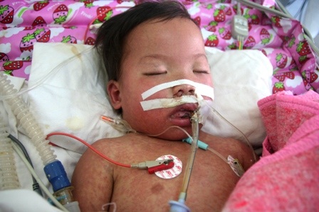 Bé 3 tuổi nhiễm trùng huyết đang rất nguy kịch - 1