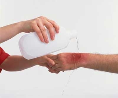 Xử trí vết thương do bỏng - 1 Xử trí vết thương do bỏng - 1