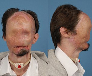 Mỹ thực hiện ca ghép mặt toàn diện đầu tiên - 4