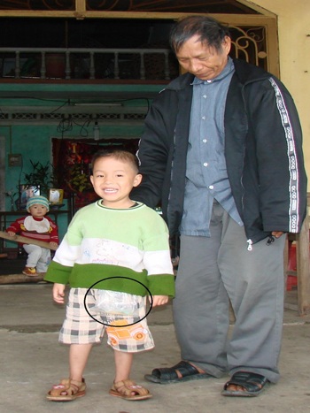 Bé trai 5 tuổi sống nhờ ống nhựa dẫn từ não - 2 Bé trai 5 tuổi sống nhờ ống nhựa dẫn từ não - 2