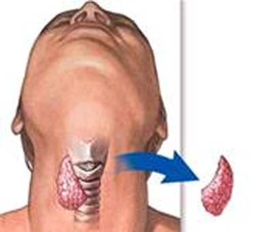 Nguyên nhân gây ung thư tuyến giáp - 1 Nguyên nhân gây ung thư tuyến giáp - 1