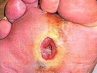 Biến chứng nguy hiểm của bệnh tiểu đường - 1