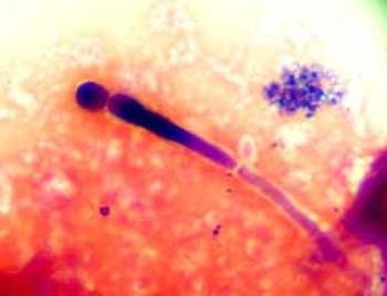 Cách phòng bệnh nấm sinh dục trong mùa nóng ẩm - 1