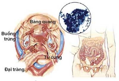Khởi phát ung thư buồng trứng là từ… ống dẫn trứng - 1 Khởi phát ung thư buồng trứng là từ… ống dẫn trứng - 1