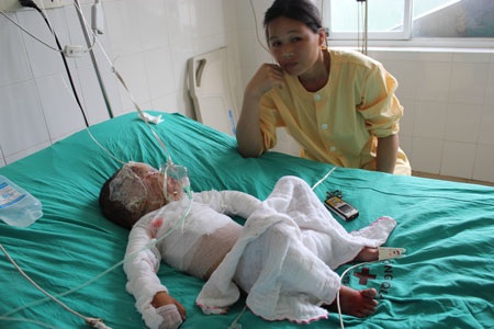 Tai nạn bỏng xăng nghiệt ngã của bé 4 tuổi - 1 Tai nạn bỏng xăng nghiệt ngã của bé 4 tuổi - 1