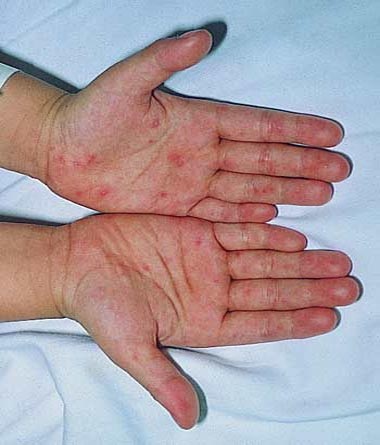 Phòng bệnh chân, tay, miệng cho trẻ nhỏ thế nào? - 1 Phòng bệnh chân, tay, miệng cho trẻ nhỏ thế nào? - 1