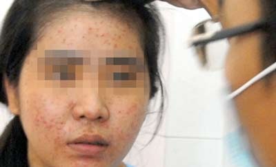 Siêu mụn sau khi tẩy trắng siêu tốc - 1