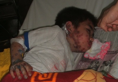 Bé trai dị ứng, tổn thương toàn thân vì phấn trang điểm - 1