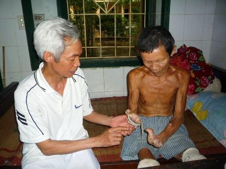 30 năm lặng thầm gắn bó với bệnh nhân phong    - 2